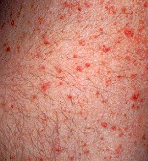 Maculopapular Rash Pictures Symptoms Treatment Causes