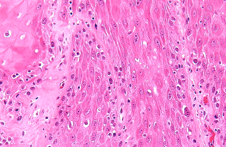 Vulvar Intraepithelial Neoplasia(VIN) Pictures, Treatment, Symptoms