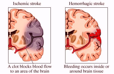 hemorrhagic stroke case study