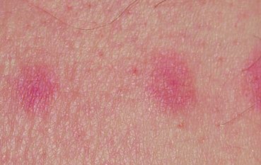 Chigger bite - Pictures, Treatment, Symptoms, Relief