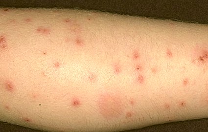 Chigger bite - Pictures, Treatment, Symptoms, Relief