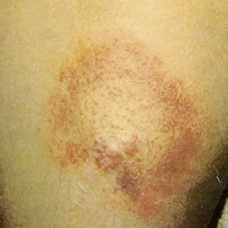 Maculopapular Rash - Pictures, Symptoms, Treatment, Causes