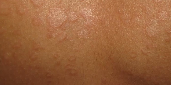 Tinea Versicolor - Pictures, Symptoms, Causes, Treatment