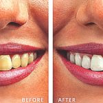 Zoom Whitening – All you wanted to know